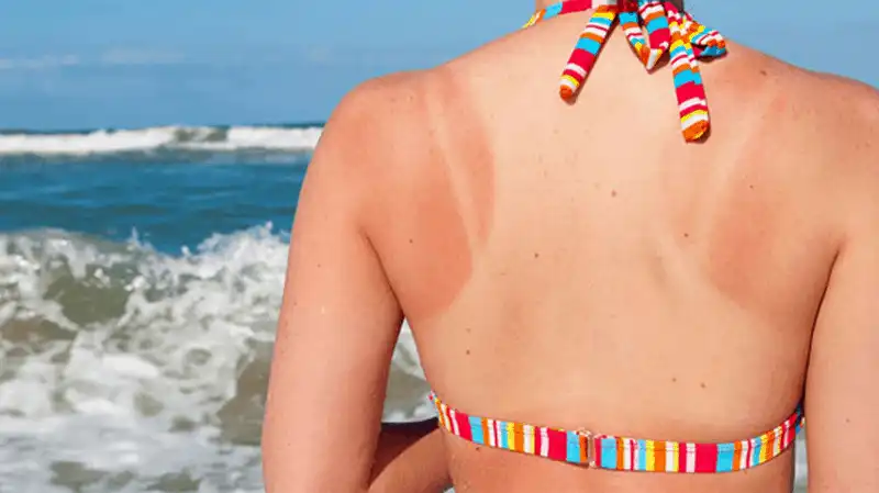 Tạp chí du lịch Wanderlust Tips - 5 mẹo nhỏ giúp bạn chăm sóc da bị cháy nắng ngày hè 